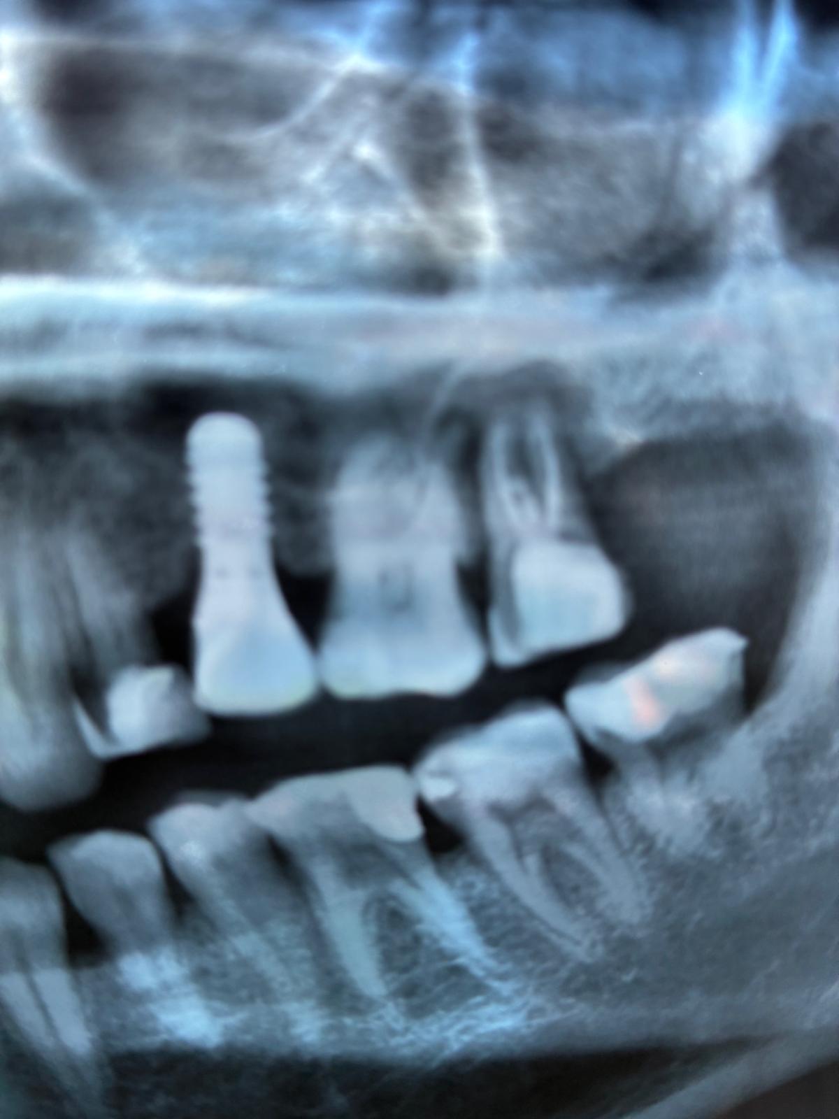 Radiografia digitale — pianificazione implantologica